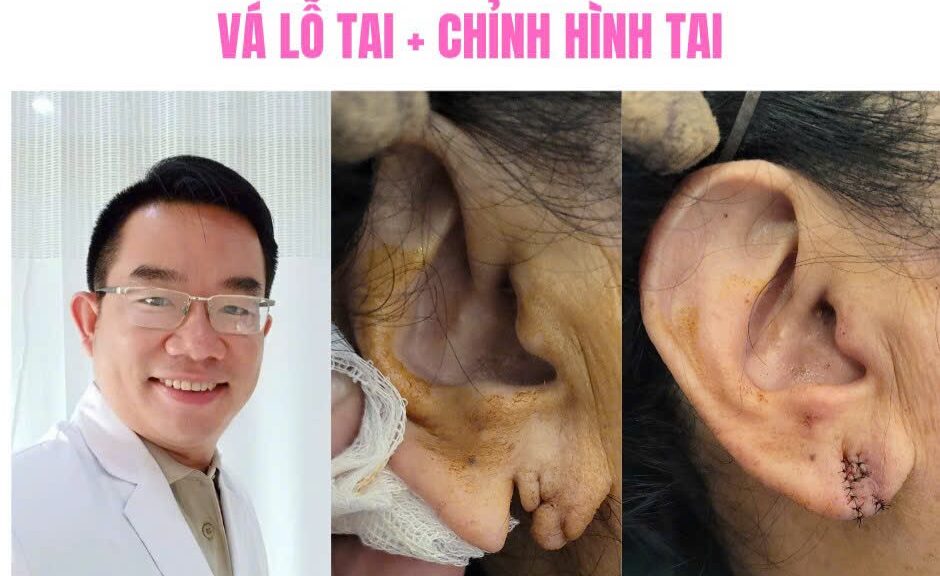 vá lỗ tai giãn rộng