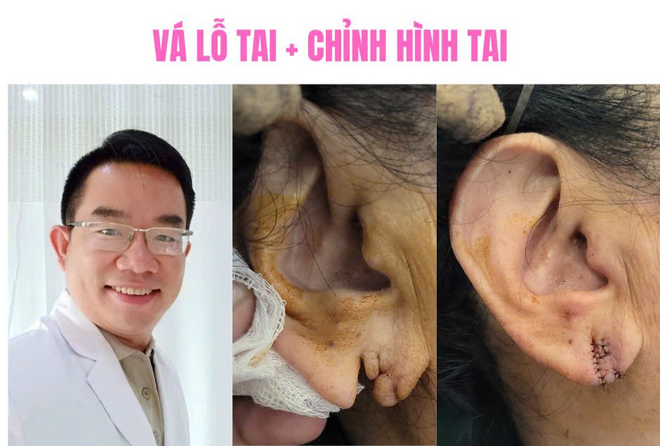 vá lỗ tai giãn rộng