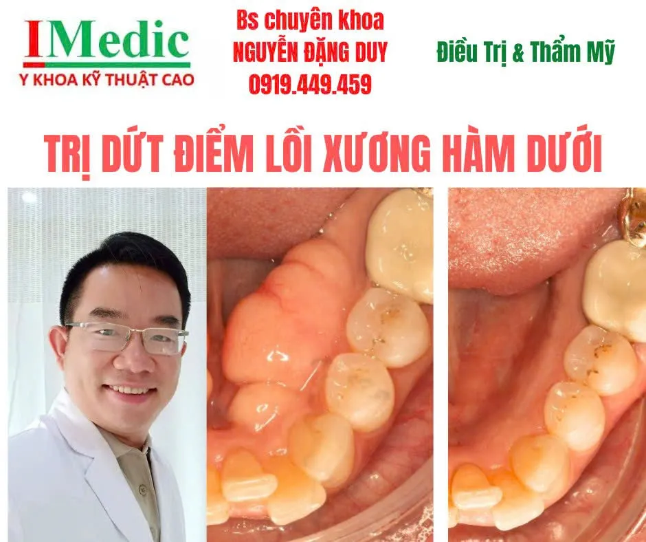 Trị U Lồi Xương Hàm Trên Hàm Dưới Tại Cà Mau Bạc Liêu Dứt Điểm An Toàn