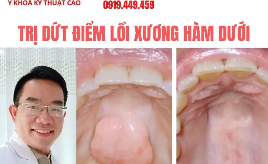 Trị U Lồi Xương Hàm Trên Hàm Dưới Tại Cà Mau Bạc Liêu Dứt Điểm An Toàn