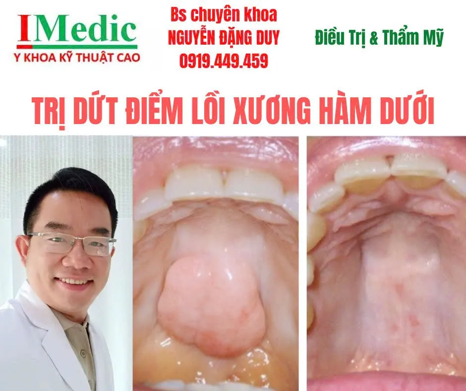 Trị U Lồi Xương Hàm Trên Hàm Dưới Tại Cà Mau Bạc Liêu Dứt Điểm An Toàn