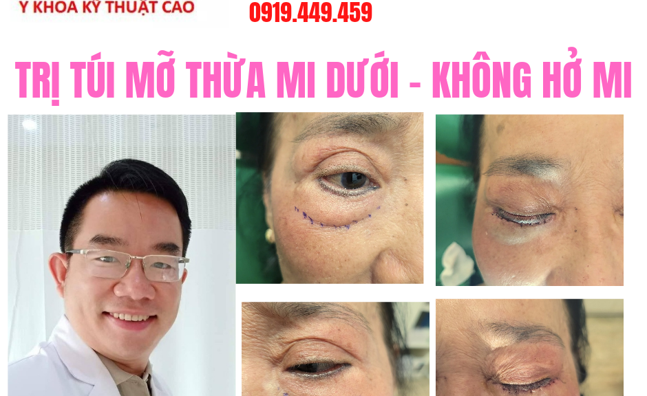 Trị Mắt Sụp Xệ Lấy Da Dư Mí Mắt An Toàn Cho Khách Hàng Cà Mau, Bạc Liêu