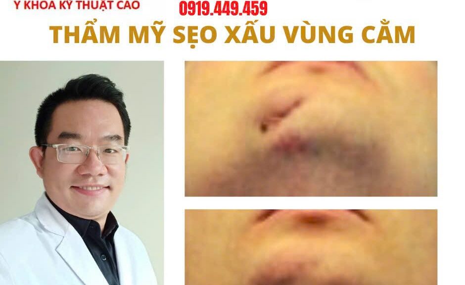 Trị sẹo cằm Cà Mau