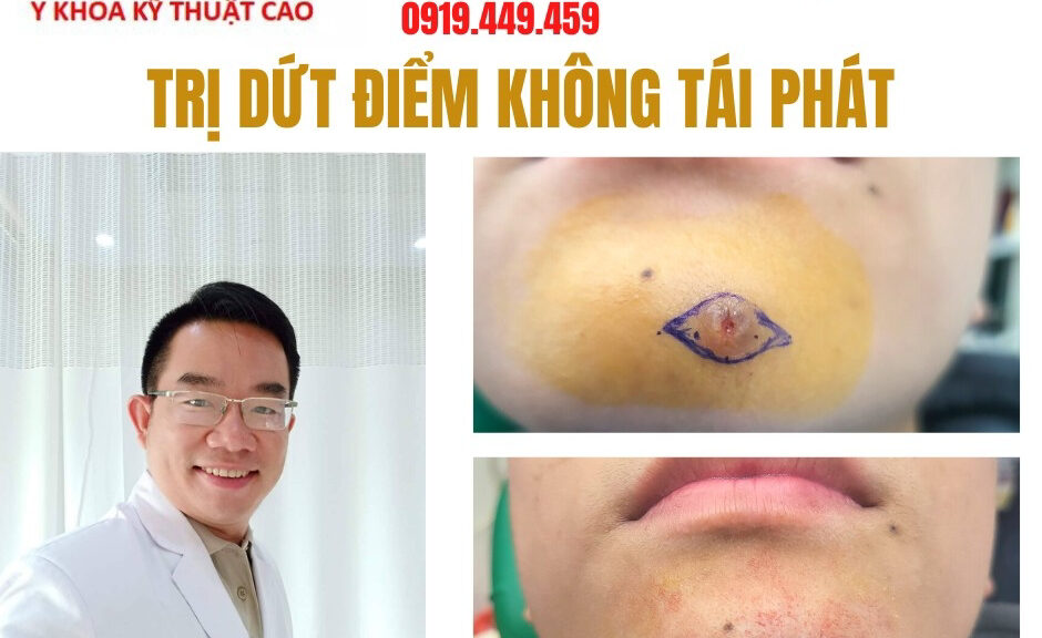 điều trị viêm nhiễm vùng cằm Cà Mau