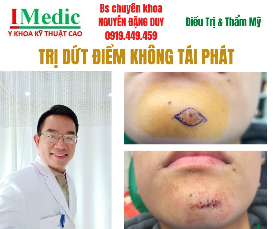 điều trị viêm nhiễm vùng cằm Cà Mau