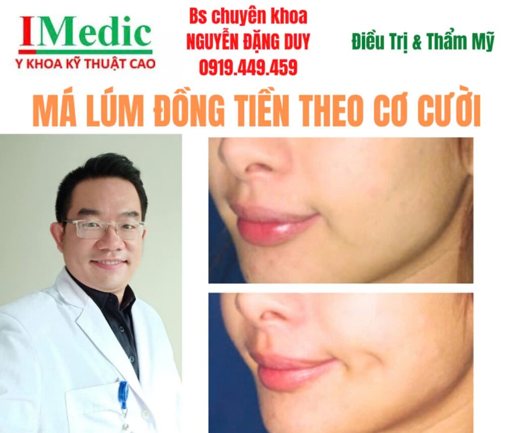 cắt má lúm đồng tiền Cà Mau