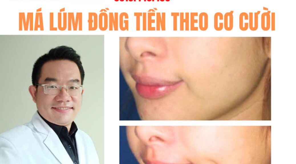 cắt má lúm đồng tiền Cà Mau
