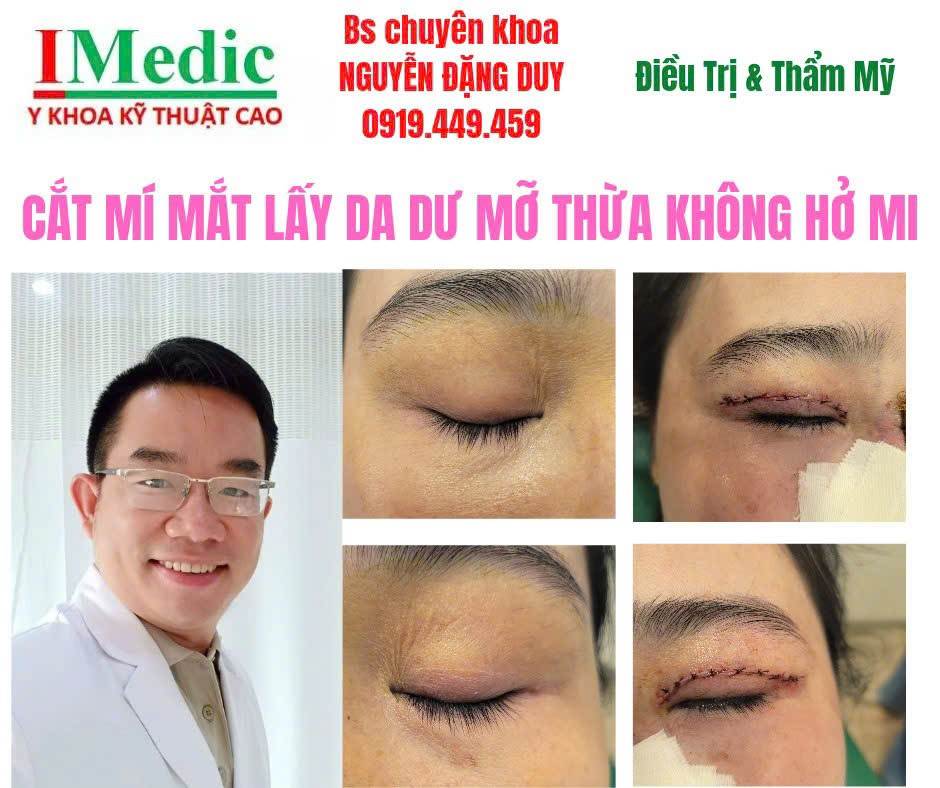 Cắt mí mắt xử lý da dư mỡ thừa trị sụp mí Cà Mau