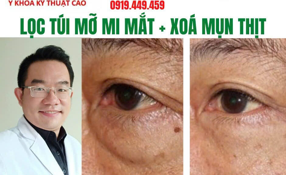 Bọng Mỡ Bướu Mỡ Mi Mắt Cà Mau: Giải Pháp Vi Phẫu An Toàn