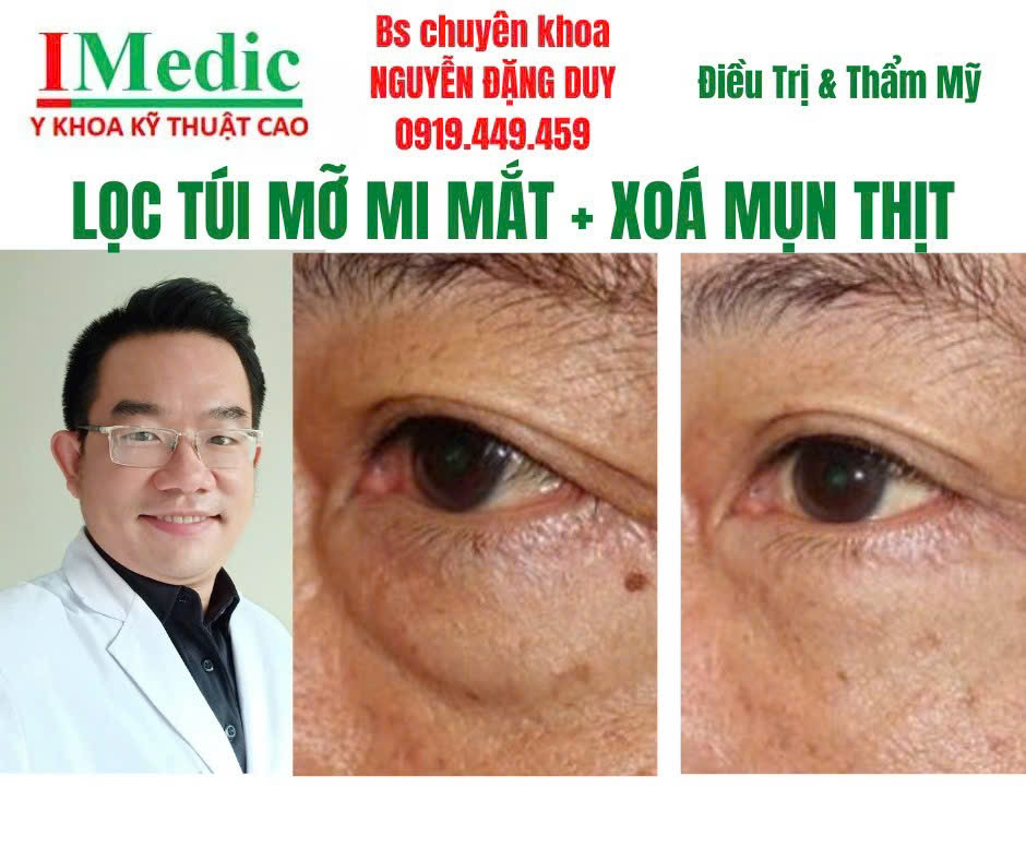 Tìm hiểu nguyên nhân và phương pháp xử lý bọng mỡ bướu mỡ mi mắt Cà Mau an toàn, chuẩn y khoa cùng Bác sĩ chuyên khoa Nguyễn Đặng Duy. Xem ngay!
