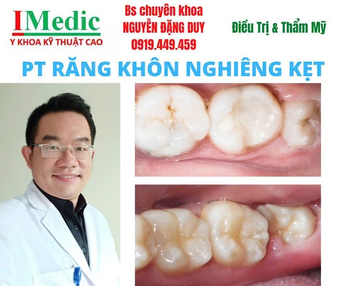Phẫu thuật nhổ răng khôn cà mau an toàn, không đau tại IMedic