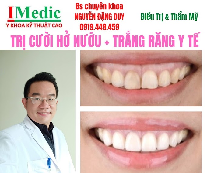 Tình trạng cười hở nướu Cà Mau là một khuyết điểm thẩm mỹ phổ biến khiến nhiều người cảm thấy ngần ngại, mất tự tin khi giao tiếp. Nụ cười đẹp đòi hỏi sự hài hòa giữa ba yếu tố: răng, nướu và môi. Khi phần mô nướu hiển thị quá 3mm lúc mỉm cười, đó chính là hiện tượng hở lợi. Hiện nay, với sự phát triển của công nghệ y khoa kỹ thuật cao, việc khắc phục tình trạng này trở nên vô cùng nhẹ nhàng, an toàn và đạt tính thẩm mỹ tối đa.