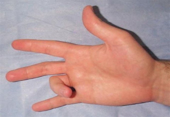 Phương pháp trị ngón tay bật an toàn, nhanh chóng và triệt để tại IMedic Cà Mau giúp khôi phục hoàn toàn vận động linh hoạt cho đôi tay của bạn.