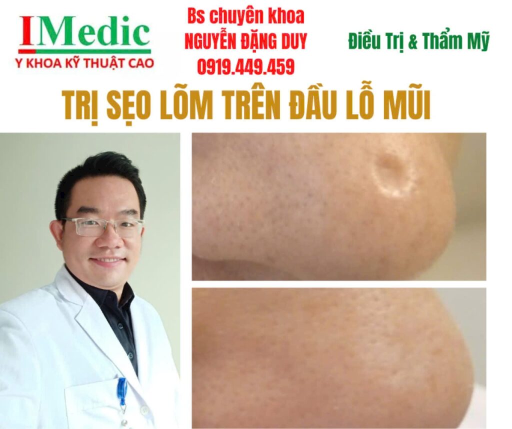 Khám phá phương pháp trị sẹo lõm cà mau an toàn, hiệu quả tận gốc tại IMedic cùng Bác sĩ Nguyễn Đặng Duy. Đặt lịch tư vấn phác đồ chuẩn y khoa ngay!
