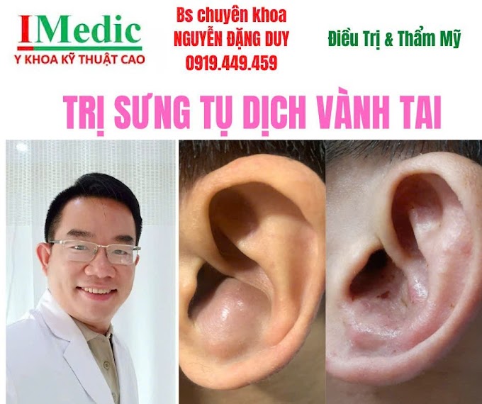 Trị tụ dịch sưng vành lỗ tai Cà Mau