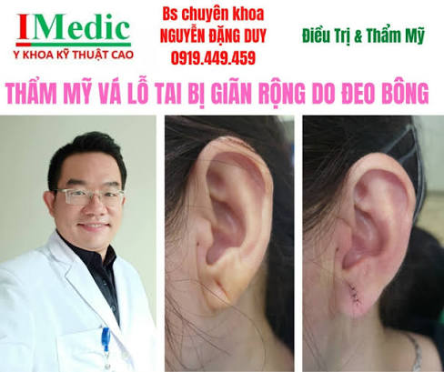 Khâu vá lỗ tai rách, giãn rộng tại Cà Mau: Phục hồi dái tai thẩm mỹ, không để lại sẹo cùng chuyên gia IMedic
