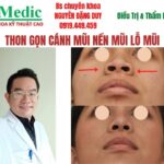 Cắt cánh mũi khép cuộn cánh mũi cà mau an toàn đẹp tự nhiên
