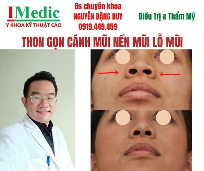 Cắt cánh mũi khép cuộn cánh mũi cà mau an toàn đẹp tự nhiên
