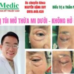 Lấy Mỡ Mí Dưới Cà Mau An Toàn & Trẻ Trung Cùng Bác Sĩ Duy