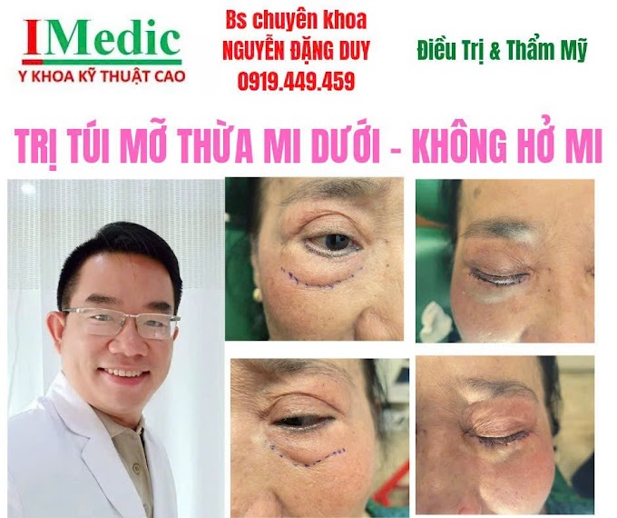 Lấy Mỡ Mí Dưới Cà Mau An Toàn & Trẻ Trung Cùng Bác Sĩ Duy