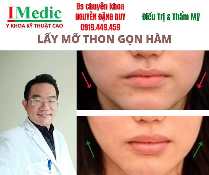 Lấy mỡ nọng 2 bên má Cà mau: Giải pháp thon gọn mặt an toàn