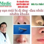 Lấy sụn mũi sau thẩm mỹ bị viêm sưng cà mau và cách xử lý