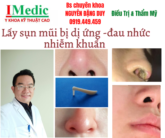 Lấy sụn mũi sau thẩm mỹ bị viêm sưng cà mau và cách xử lý