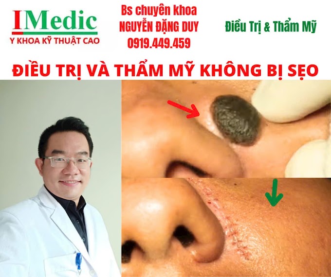 Mổ Mụt Ruồi Cà Mau An Toàn Chuẩn Y Khoa Không Để Lại Sẹo IMedic 0919449459