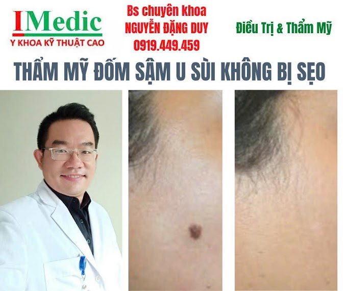 Mổ cắt nốt ruồi to lớn sùi chồi Cà Mau an toàn không sẹo