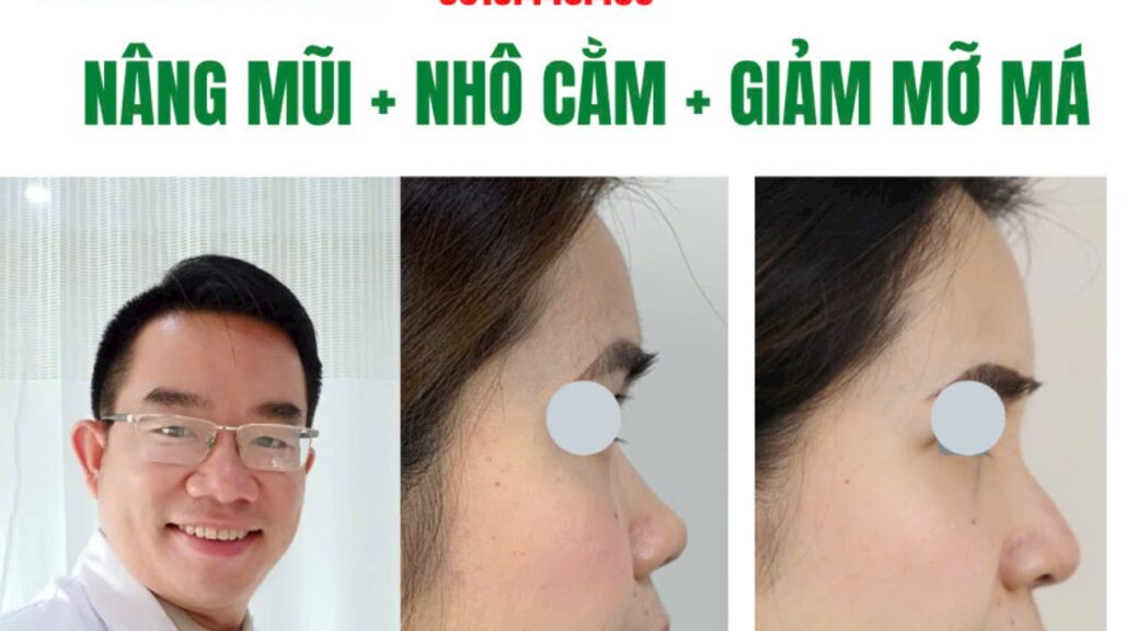 Sửa mũi độn cằm thon gọn mỡ má Vline Cà Mau chuẩn y khoa