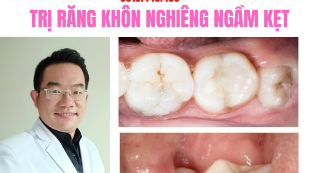 Nhổ Răng Khôn Cà Mau An Toàn, Không Đau Cùng Bác Sĩ Duy