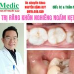 Nhổ Răng Khôn Cà Mau An Toàn, Không Đau Cùng Bác Sĩ Duy