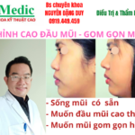 Sửa Mũi Nâng Mũi Cà Mau An Toàn Chuẩn Y Khoa