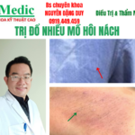 Trị Mồ Hôi Nách Và Khử Mùi Hôi Nách Cà Mau Hiệu Quả