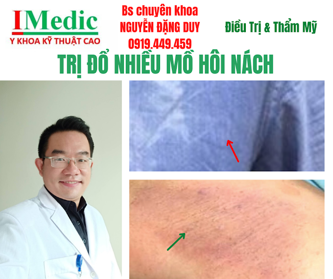 Trị Mồ Hôi Nách Và Khử Mùi Hôi Nách Cà Mau Hiệu Quả