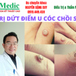 Trị mụt cóc chồi sùi cà mau an toàn, triệt để cùng bác sĩ