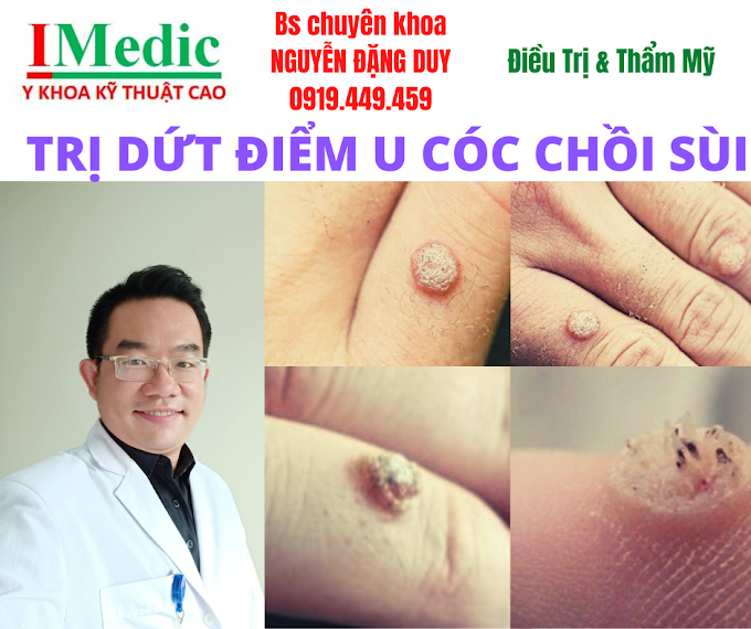 Trị mụt cóc chồi sùi cà mau an toàn, triệt để cùng bác sĩ