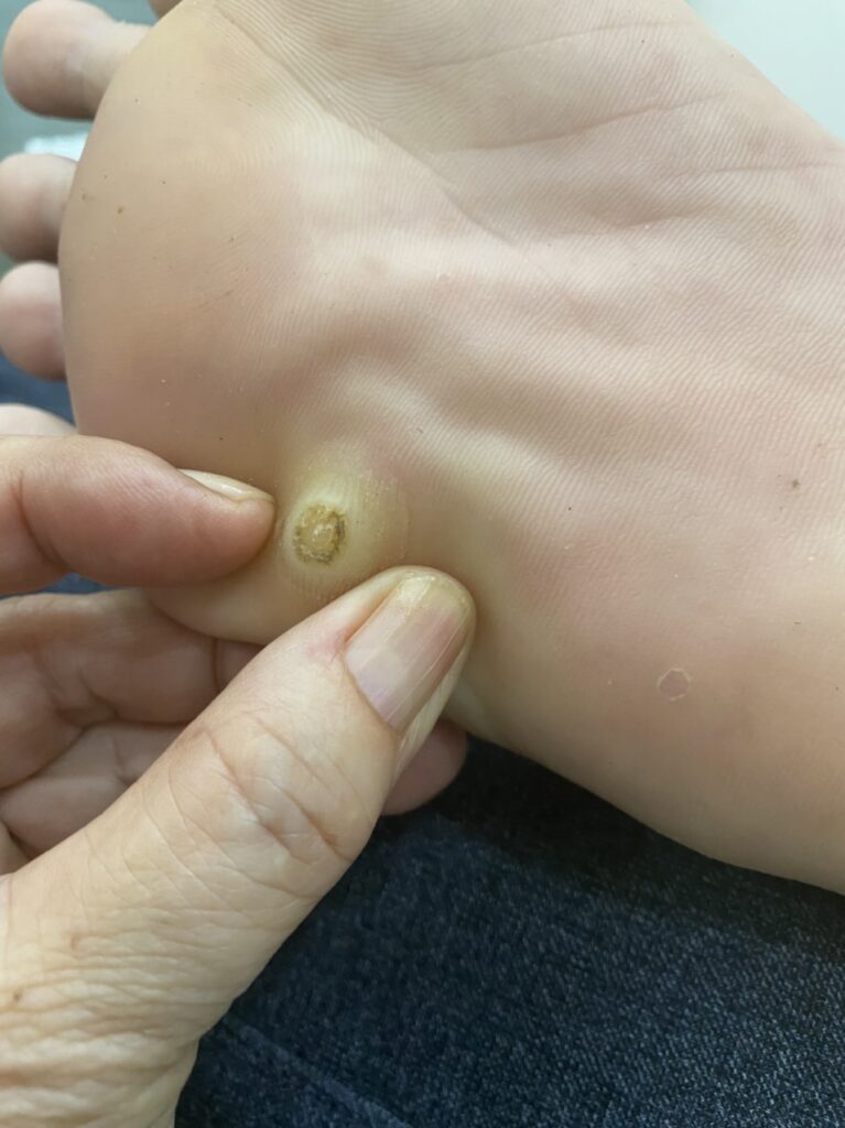 Hướng dẫn trị mụt ké bàn chân Cà Mau tận gốc, an toàn, không đau rát. Đến ngay IMedic Cà Mau để được Bác sĩ Chuyên khoa trực tiếp thăm khám.