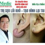 Trị sẹo lồi lỗ tai do đeo bông nhiễm trùng Cà mau