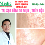 Trị Sẹo Lõm Do Mụn Viêm Thủy Đậu An Toàn Tại Cà Mau