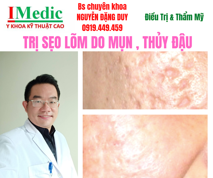 Trị Sẹo Lõm Do Mụn Viêm Thủy Đậu An Toàn Tại Cà Mau