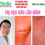 Trị sẹo lõm do chấm thuốc phá nốt ruồi chuẩn y khoa