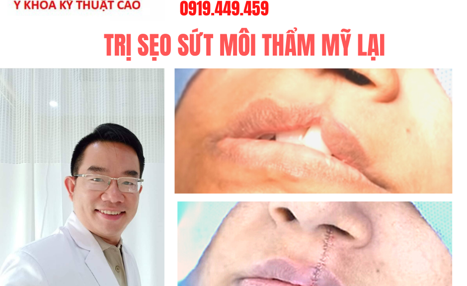 Trị sẹo sứt môi Cà Mau chuẩn y khoa an toàn hiệu quả
