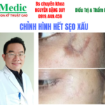 Trị Sẹo Thâm Đen Cà Mau An Toàn Chuẩn Y Khoa Tại IMedic