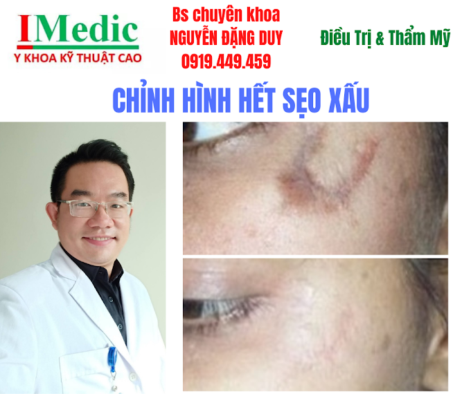 Trị Sẹo Thâm Đen Cà Mau An Toàn Chuẩn Y Khoa Tại IMedic