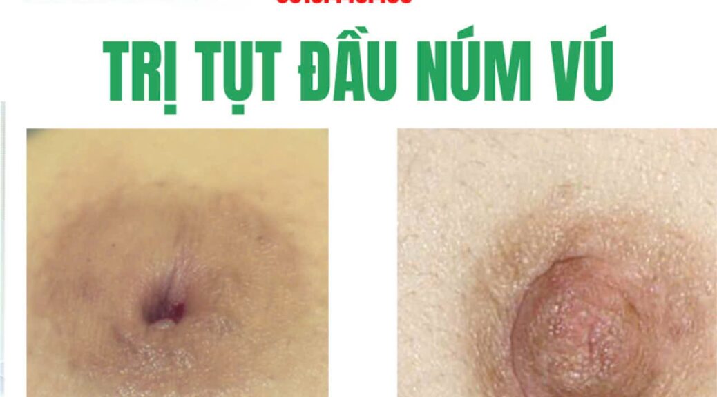 Trị núm vú bị tụt lõm an toàn cùng Bác sĩ chuyên khoa Cà Mau