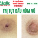 Trị núm vú bị tụt lõm an toàn cùng Bác sĩ chuyên khoa Cà Mau