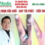 Trị Mụt Cốc Sùi Cà Mau An Toàn, Dứt Điểm Chuẩn Y Khoa