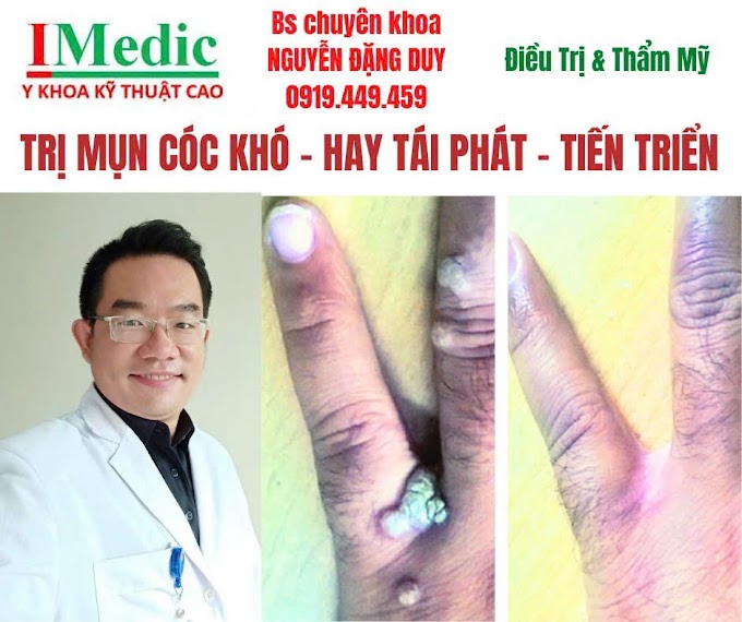 Trị Mụt Cốc Sùi Cà Mau An Toàn, Dứt Điểm Chuẩn Y Khoa