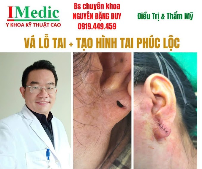 Vá Lỗ Tai Giãn Rộng Giải Pháp Thẩm Mỹ An Toàn Tại Cà Mau